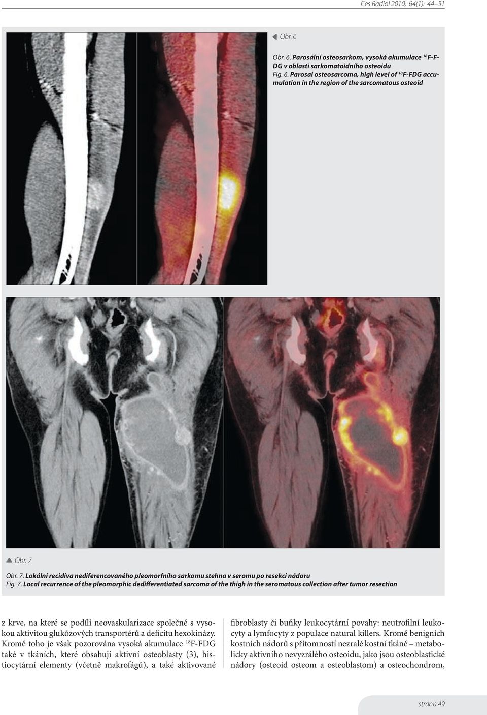 Lokální recidiva nediferencovaného pleomorfního sarkomu stehna v seromu po resekci nádoru Fig. 7.
