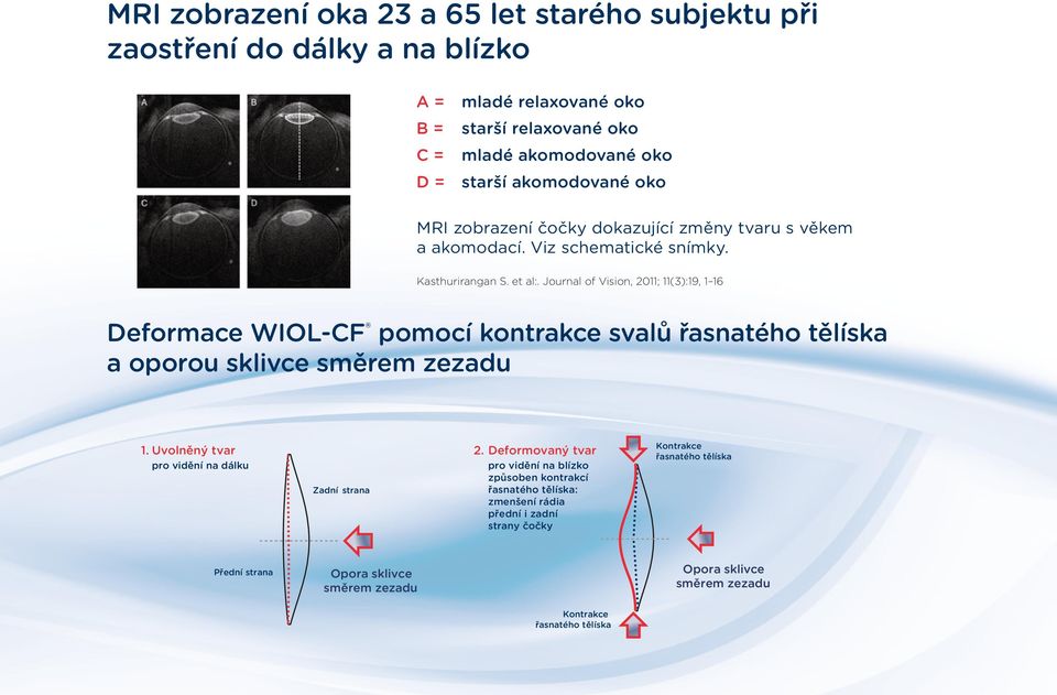 Journal of Vision, 011; 11(3):19, 1 1 Deformace WIOL-CF pomocí kontrakce svalů řasnatého tělíska a oporou sklivce směrem zezadu 1. Uvolněný tvar pro vidění na dálku Zadní strana.