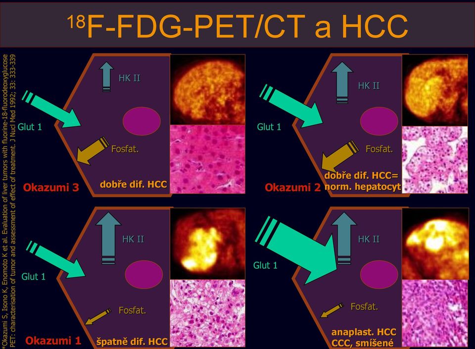 assessment of effect of treatment. J Nucl Med 1992; 33: 333-339 Glut 1 Glut 1 Okazumi 3 dobře dif.