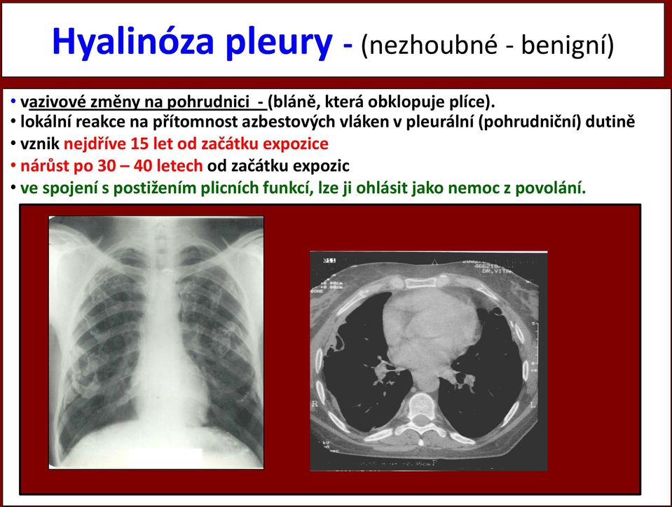 lokální reakce na přítomnost azbestových vláken v pleurální (pohrudniční) dutině vznik