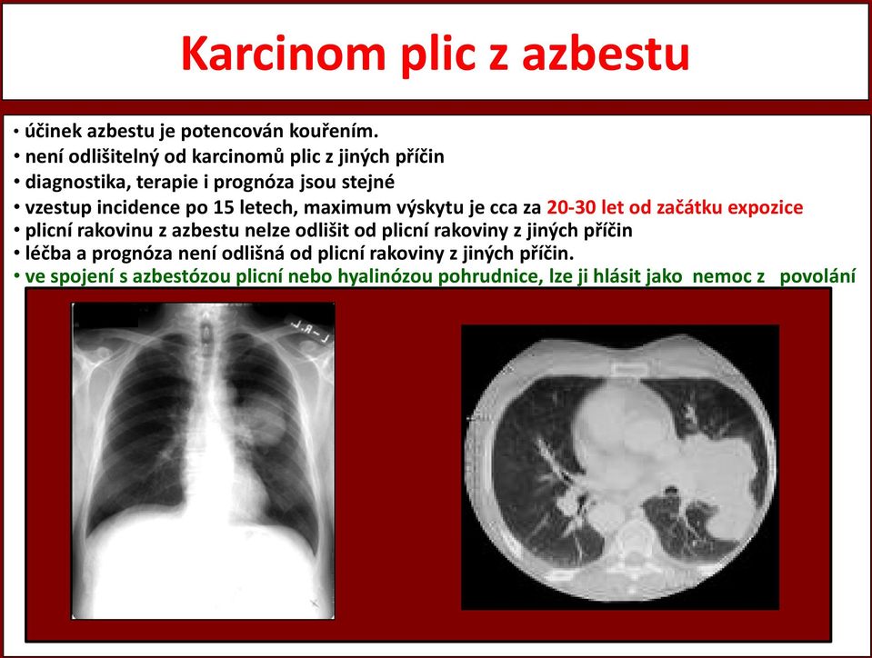 letech, maximum výskytu je cca za 20-30 let od začátku expozice plicní rakovinu z azbestu nelze odlišit od plicní