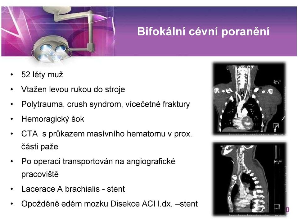 hematomu v prox.