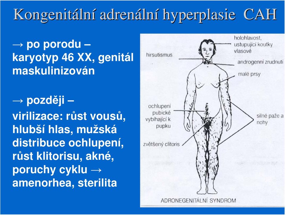 virilizace: růst vousů, hlubší hlas, mužská distribuce