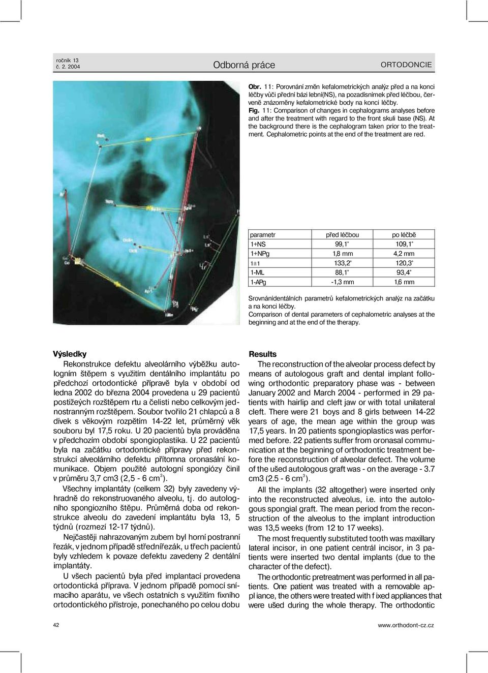 11: Comparison of changes in cephalograms analyses before and after the treatment with regard to the front skuli base (NS). At the background there is the cephalogram taken prior to the treatment.