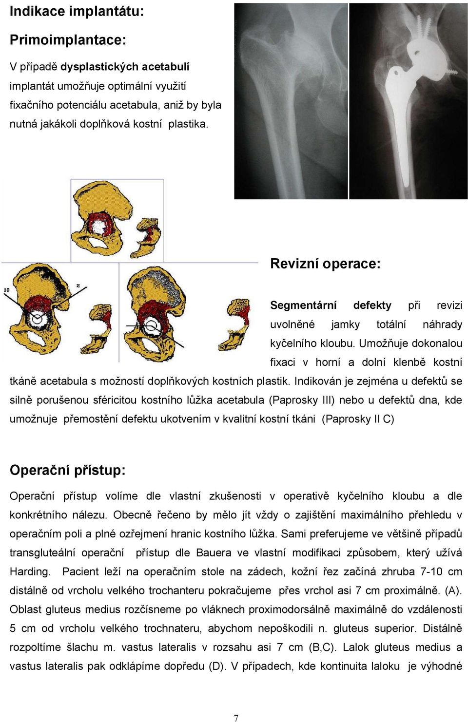 Umožňuje dokonalou fixaci v horní a dolní klenbě kostní tkáně acetabula s možností doplňkových kostních plastik.