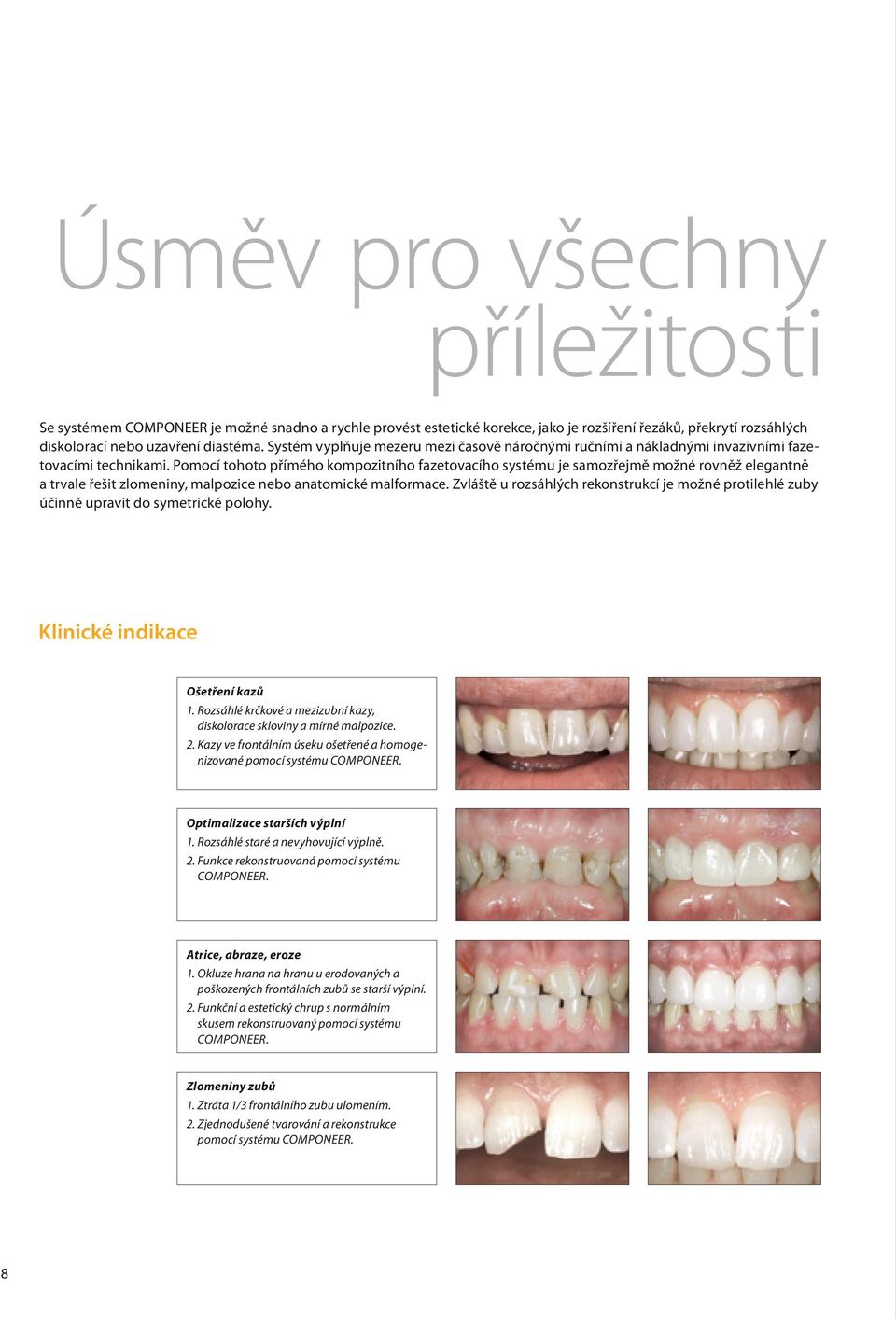 Pomocí tohoto přímého kompozitního fazetovacího systému je samozřejmě možné rovněž elegantně a trvale řešit zlomeniny, malpozice nebo anatomické malformace.