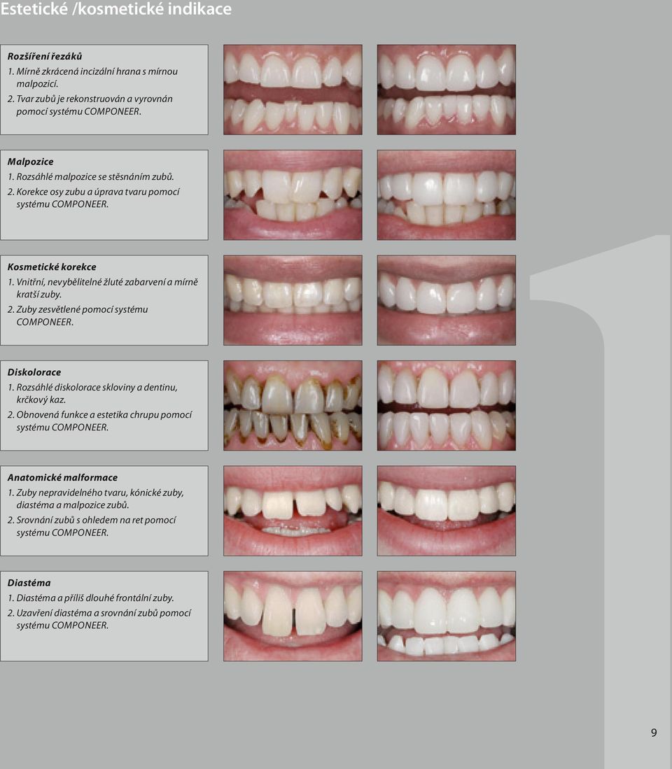 Diskolorace 1. Rozsáhlé diskolorace skloviny a dentinu, krčkový kaz. 2. Obnovená funkce a estetika chrupu pomocí systému Componeer. Anatomické malformace 1.