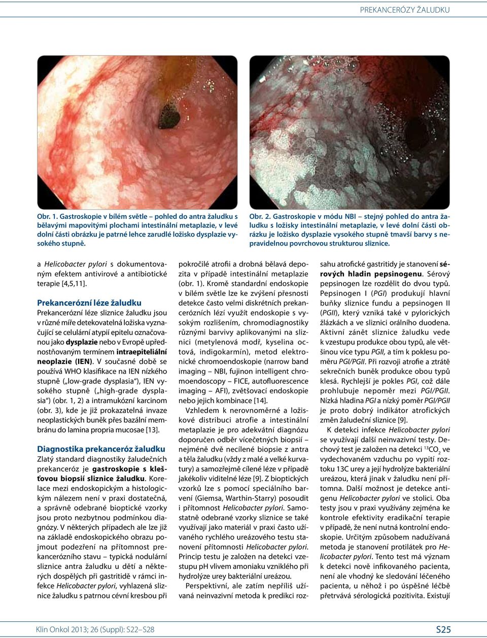 2. Gastroskopie v módu NBI stejný pohled do antra žaludku s ložisky intestinální metaplazie, v levé dolní části obrázku je ložisko dysplazie vysokého stupně tmavší barvy s nepravidelnou povrchovou