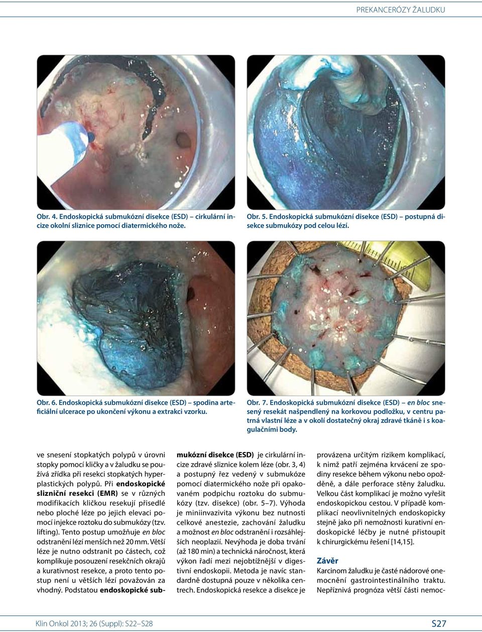 Endoskopická submukózní disekce (ESD) en bloc snesený resekát našpendlený na korkovou podložku, v centru patrná vlastní léze a v okolí dostatečný okraj zdravé tkáně i s koagulačními body.