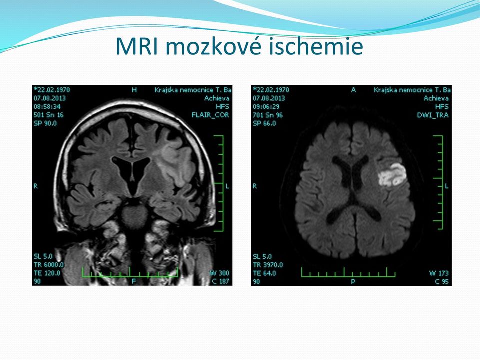 ischemie