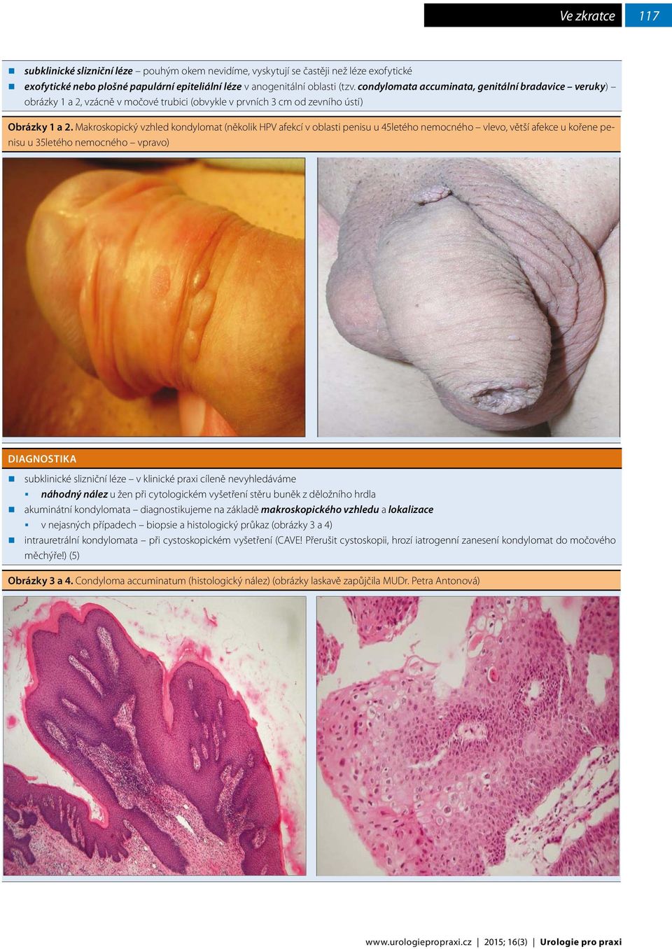Makroskopický vzhled kondylomat (několik HPV afekcí v oblasti penisu u 45letého nemocného vlevo, větší afekce u kořene penisu u 35letého nemocného vpravo) DIAGNOSTIKA subklinické slizniční léze v