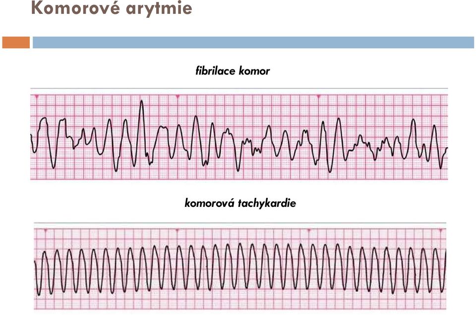 fibrilace