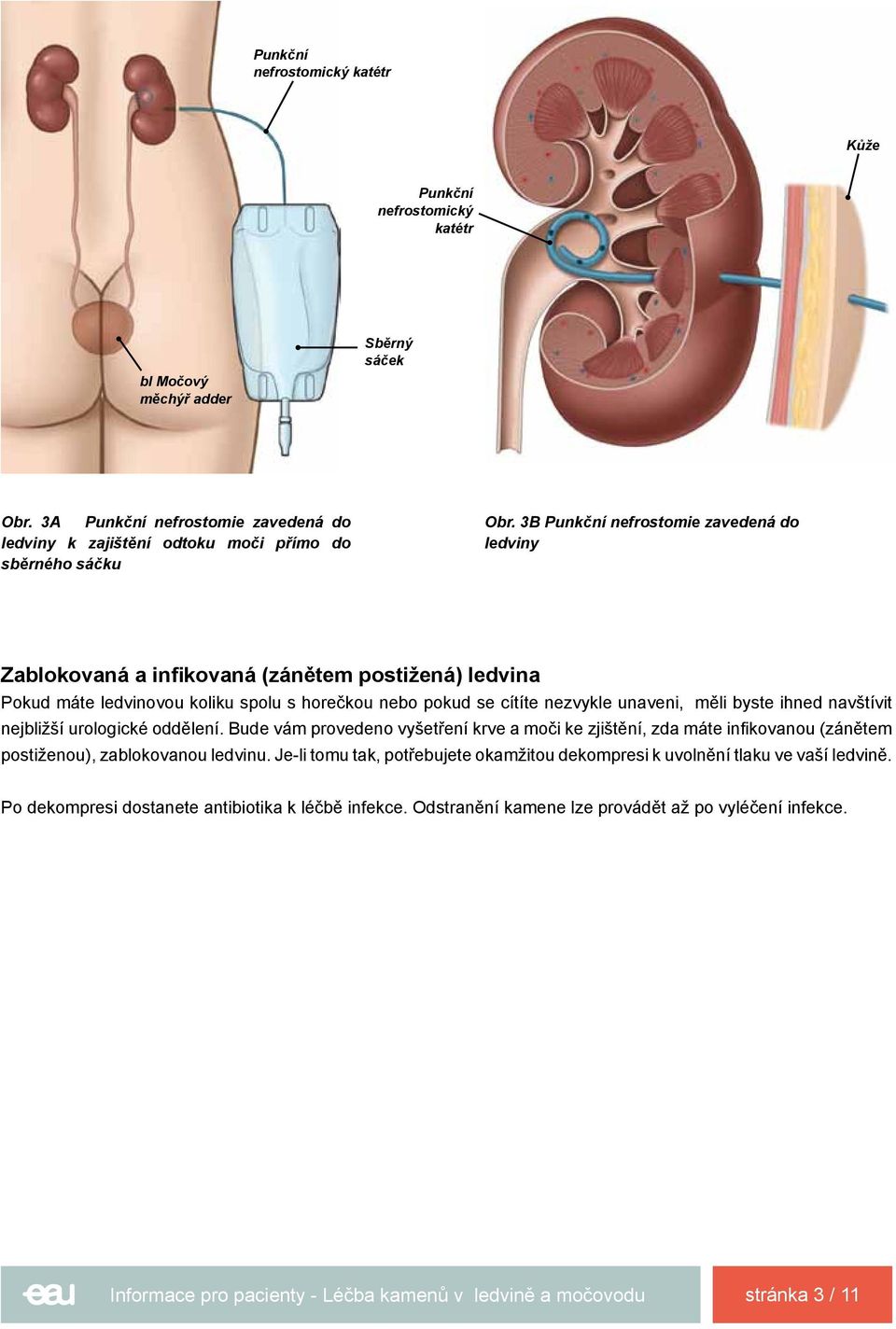 3B Punkční nefrostomie zavedená do ledviny Zablokovaná a infikovaná (zánětem postižená) ledvina Pokud máte ledvinovou koliku spolu s horečkou nebo pokud se cítíte nezvykle unaveni, měli