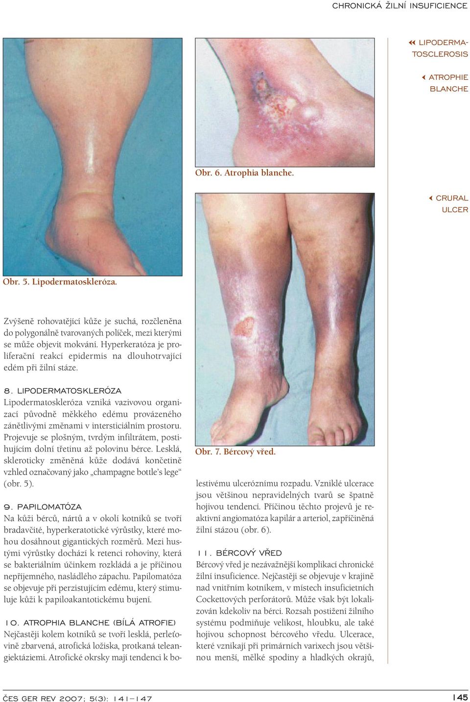 Hyperkeratóza je proliferační reakcí epidermis na dlouhotrvající edém při žilní stáze. 8.