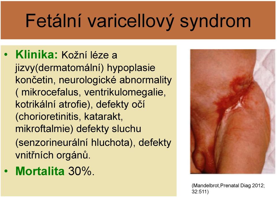 atrofie), defekty očí (chorioretinitis, katarakt, mikroftalmie) defekty sluchu