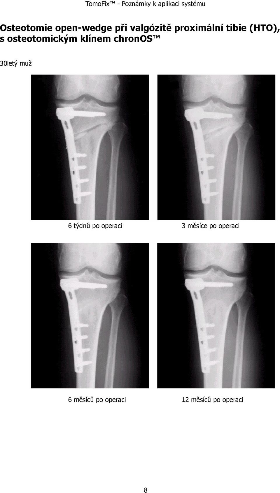 klínem chronos 30letý muž 6 týdnů po operaci