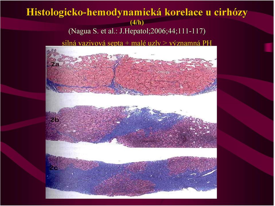 : J.Hepatol;2006;44;111 ;2006;44;111-117)