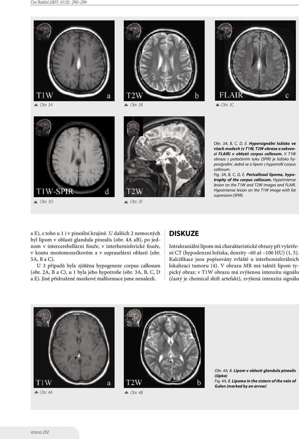 Hyperintense lesion on the T1W and T2W images and FLAIR. Hypointense lesion on the T1W image with fat supression (SPIR). a E), z toho u 1 i v pineální krajině.