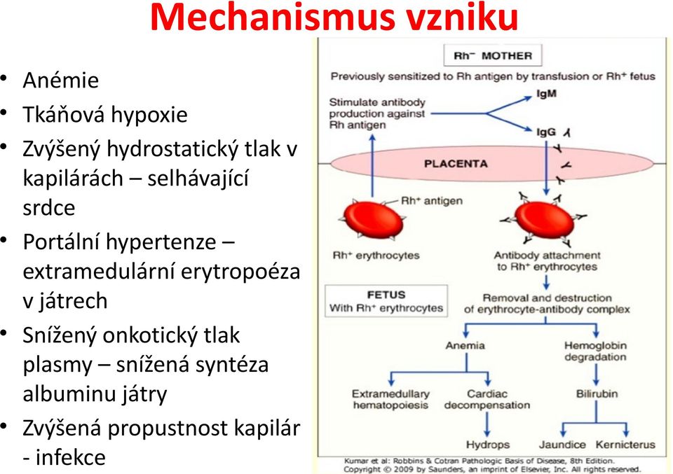 extramedulární erytropoéza v játrech Snížený onkotický tlak