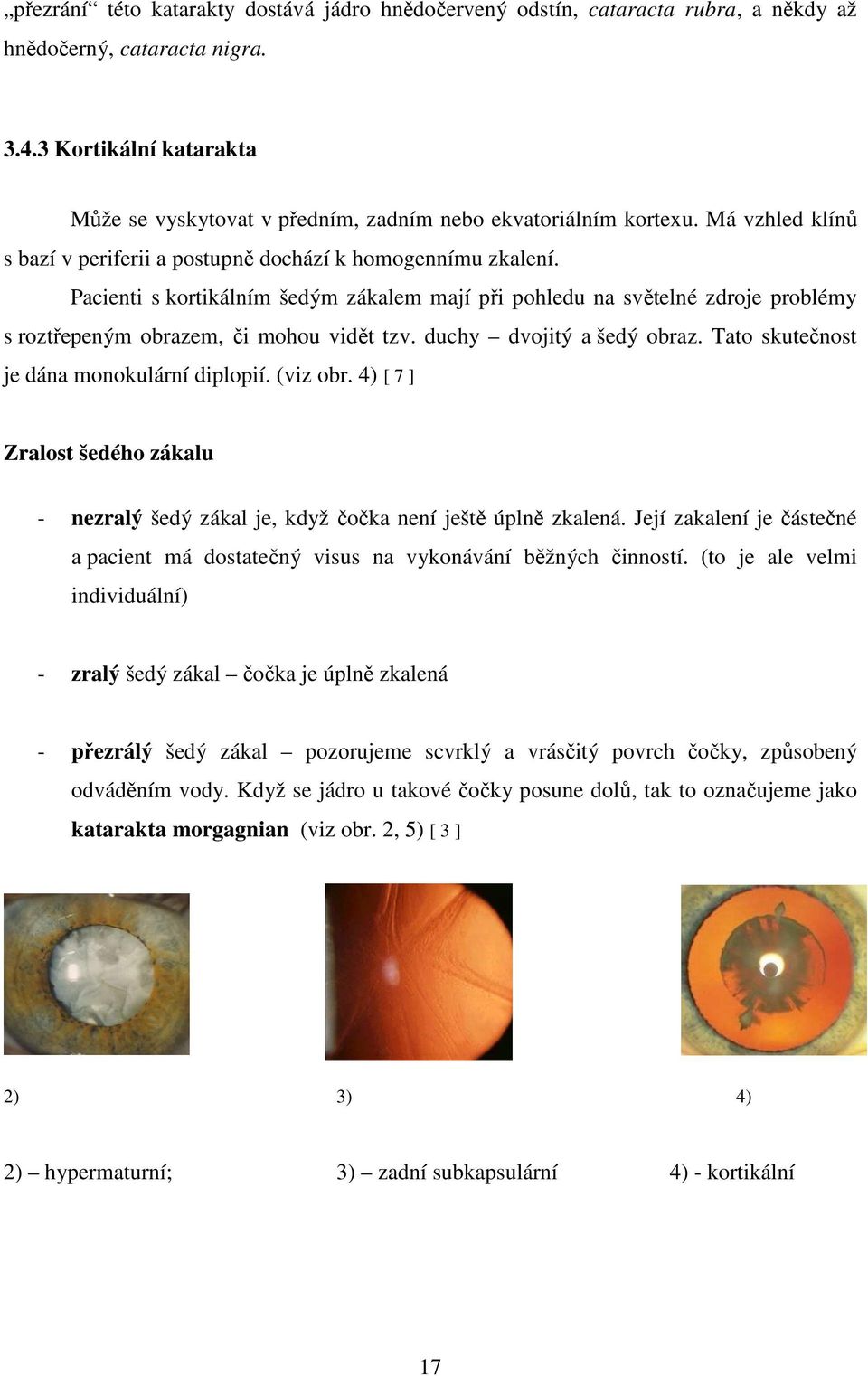 Pacienti s kortikálním šedým zákalem mají při pohledu na světelné zdroje problémy s roztřepeným obrazem, či mohou vidět tzv. duchy dvojitý a šedý obraz. Tato skutečnost je dána monokulární diplopií.