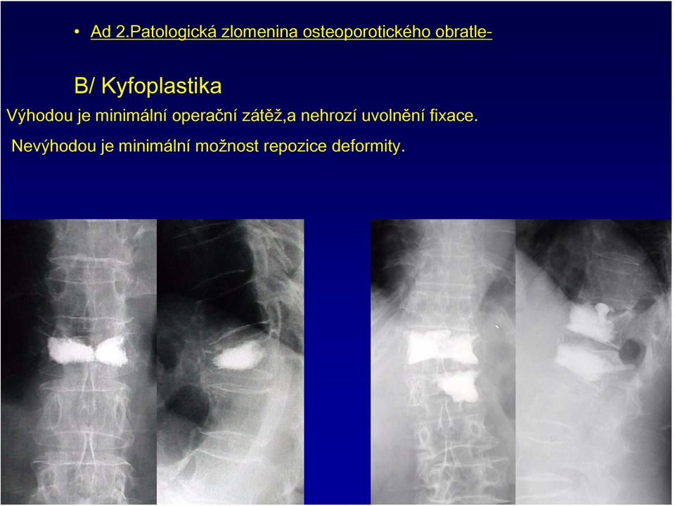 operační zátěž,a nehrozí uvolnění fixace.