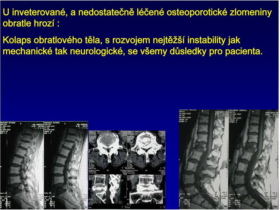 obratlového těla, s rozvojem nejtěžší instability