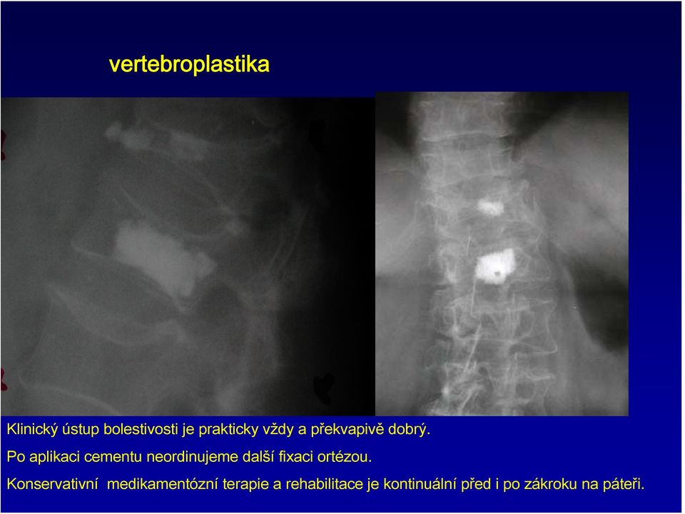 Po aplikaci cementu neordinujeme další fixaci ortézou.