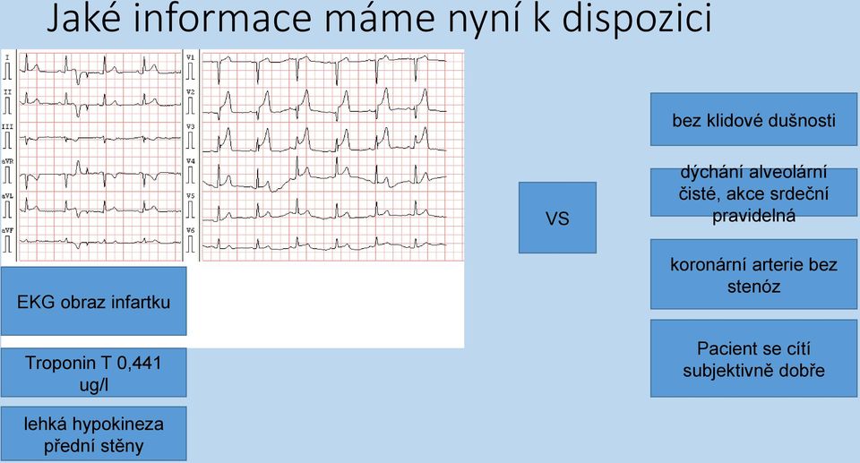 infartku Troponin T 0,441 ug/l koronární arterie bez stenóz