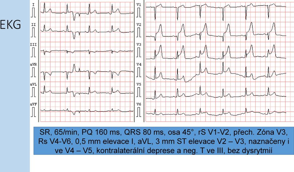 Zóna V3, Rs V4-V6, 0,5 mm elevace I, avl, 3 mm ST