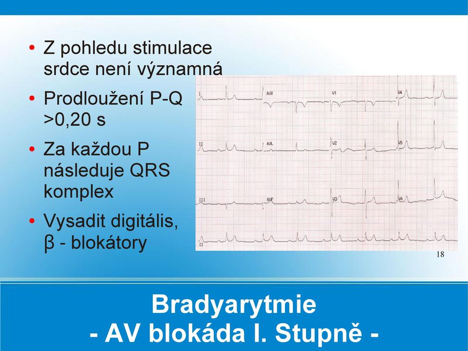 následuje QRS komplex Vysadit digitális, β