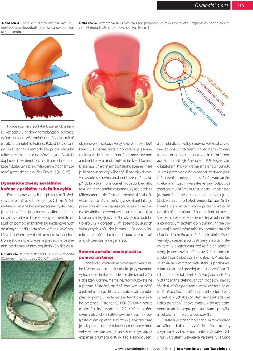 reimplantační operace, ovšem za cenu výše zmíněné ztráty dynamické elasticity aortálního kořene.