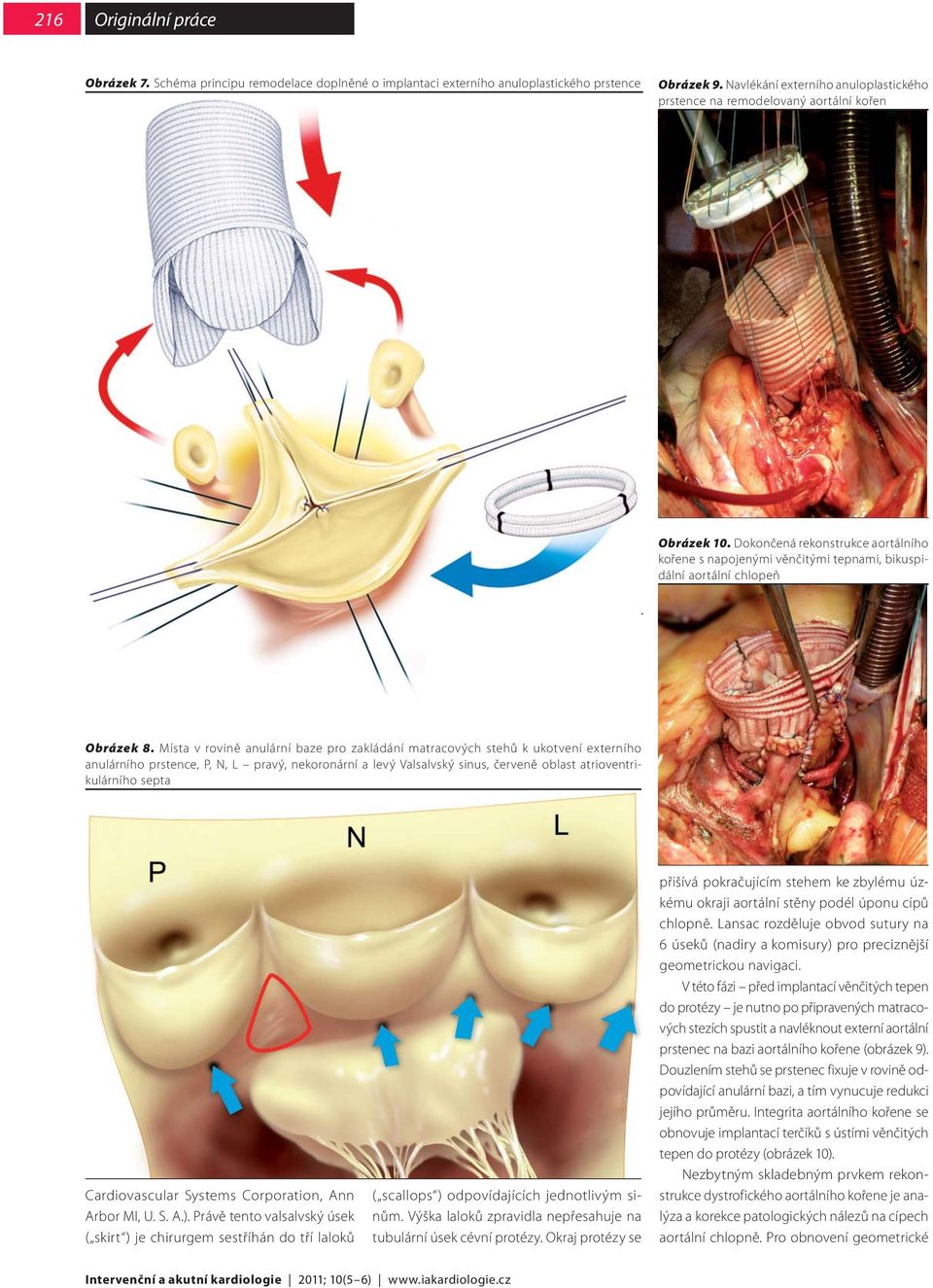 Dokončená rekonstrukce aortálního kořene s napojenými věnčitými tepnami, bikuspidální aortální chlopeň Obrázek 8.