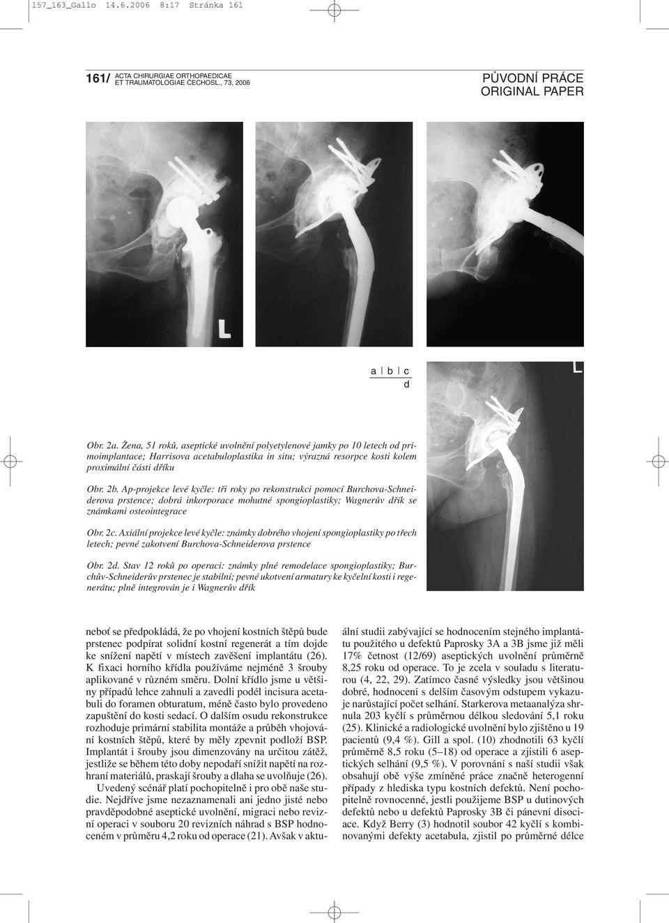 Ap-projekce levé kyčle: tři roky po rekonstrukci pomocí Burchova-Schneiderova prstence; dobrá inkorporace mohutné spongioplastiky; Wagnerův dřík se známkami osteointegrace Obr. 2c.