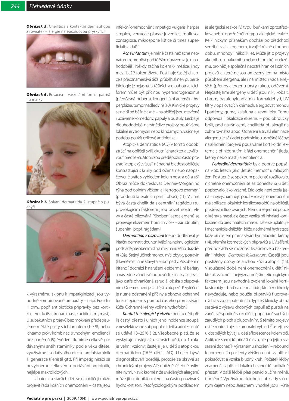 U subakutních projevů bez mokvání předepisujeme měkké pasty s ichtamolem (1 3 %, nebo Ichtamo pro) v kombinaci s vhodnými emoliencii bez parfémů (9).