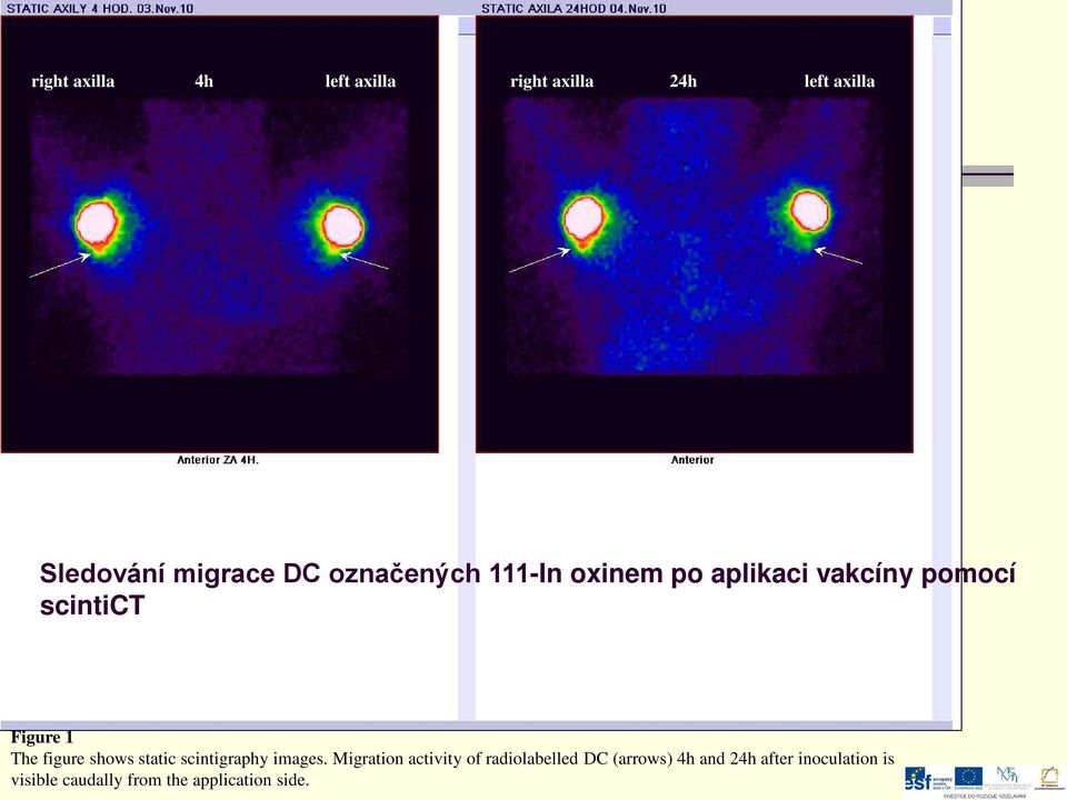 migration of the DC injection site Figure 1 The figure shows static scintigraphy images.
