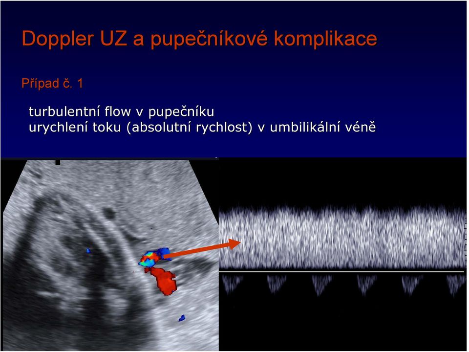 . 1 turbulentní flow v pupečníku