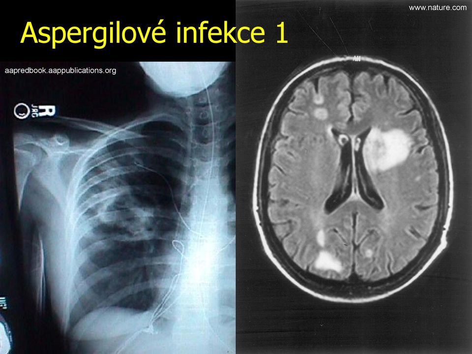 infekce 1