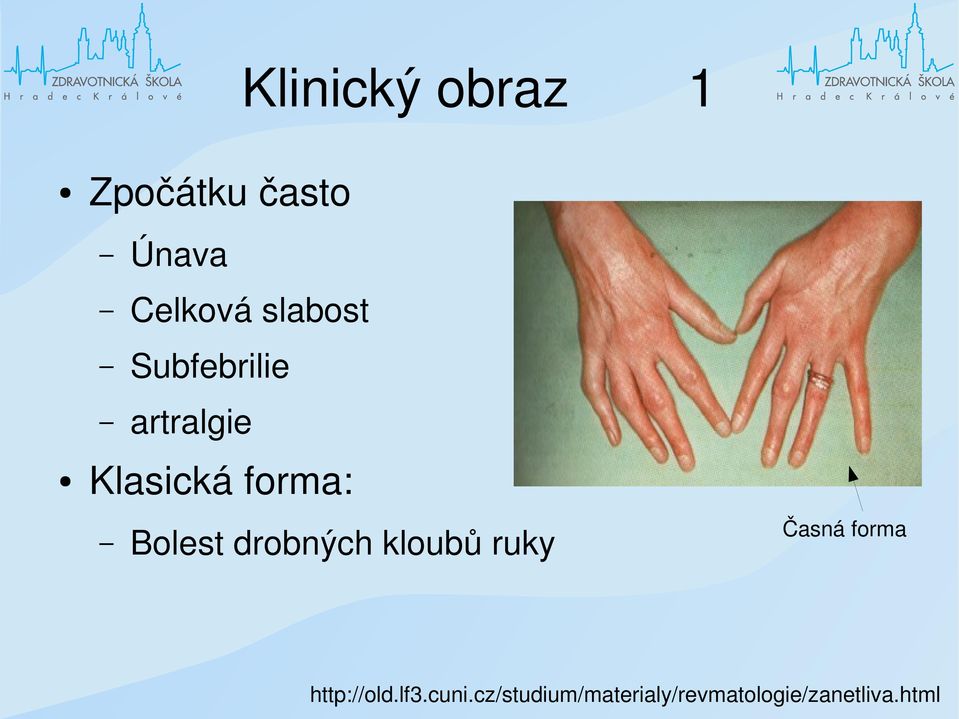 Bolest drobných kloubů ruky Časná forma