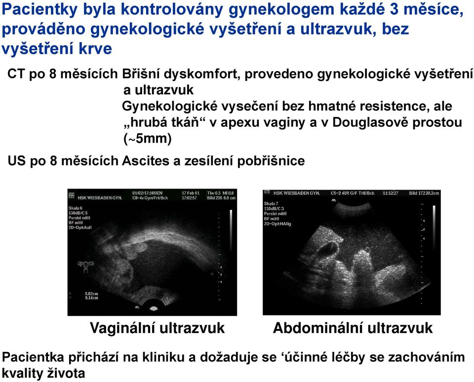 resistence, ale hrubá tkáň v apexu vaginy a v Douglasově prostou (~5mm) US po 8 měsících Ascites a zesílení pobřišnice