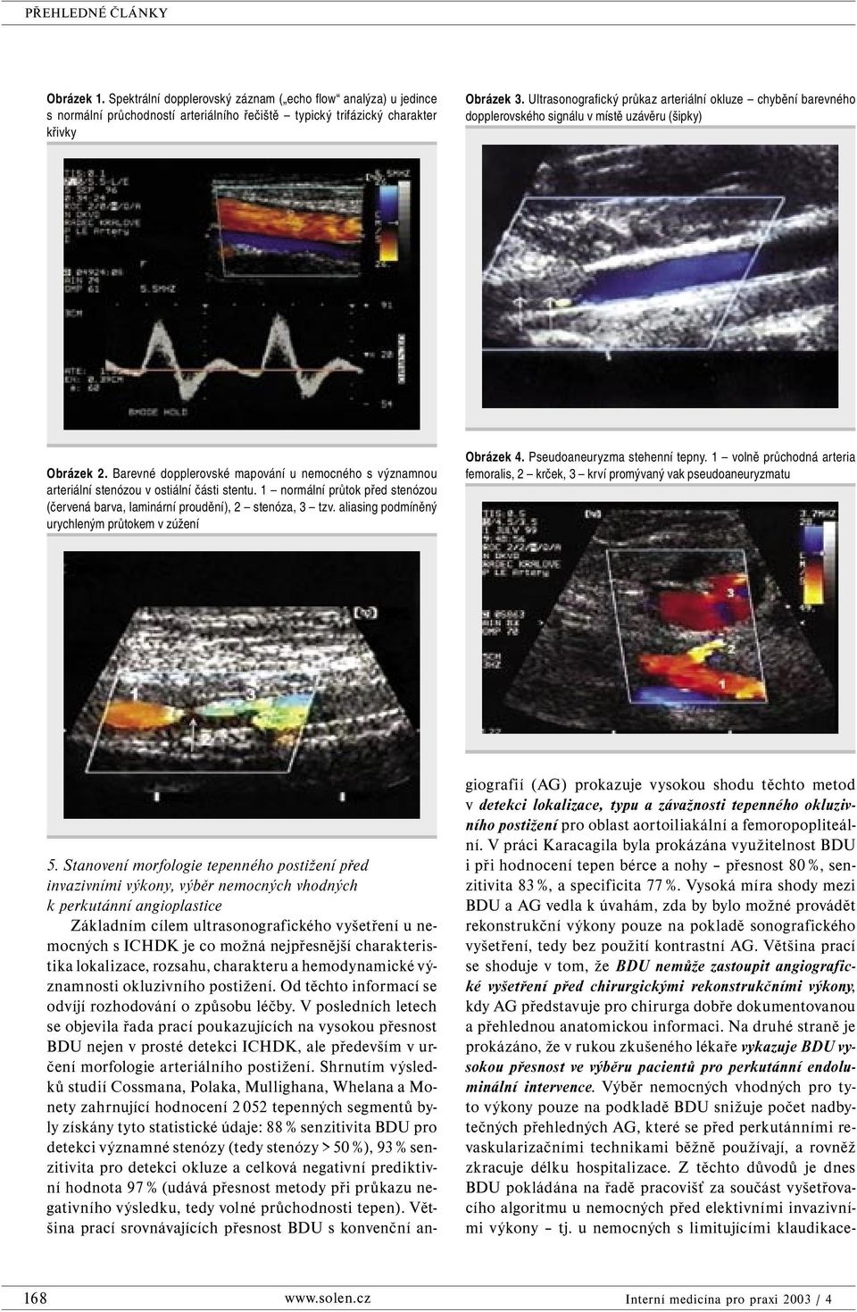 Barevné dopplerovské mapování u nemocného s významnou arteriální stenózou v ostiální části stentu. 1 normální průtok před stenózou (červená barva, laminární proudění), 2 stenóza, 3 tzv.