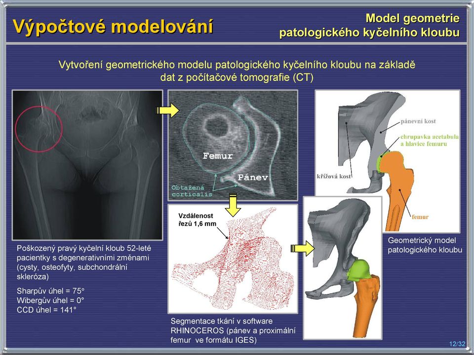 pravý kyčelní kloub 52-leté pacientky s degenerativními změnami (cysty, osteofyty, subchondrální skleróza) Sharpův úhel =