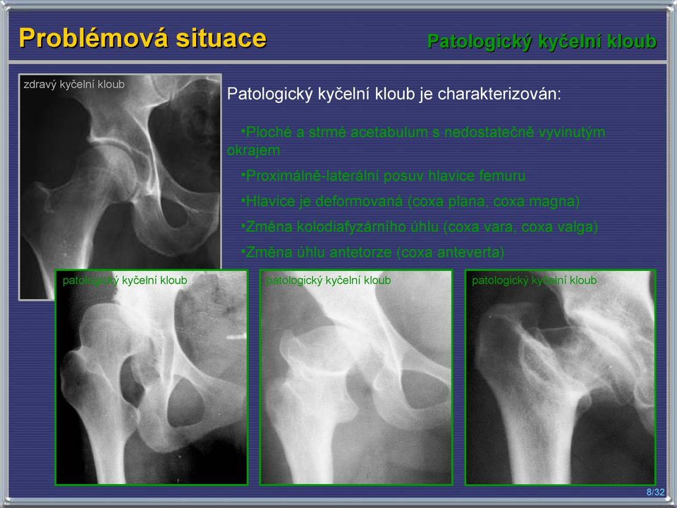 hlavice femuru Hlavice je deformovaná (coxa plana, coxa magna) Změna kolodiafyzárního úhlu (coxa vara, coxa