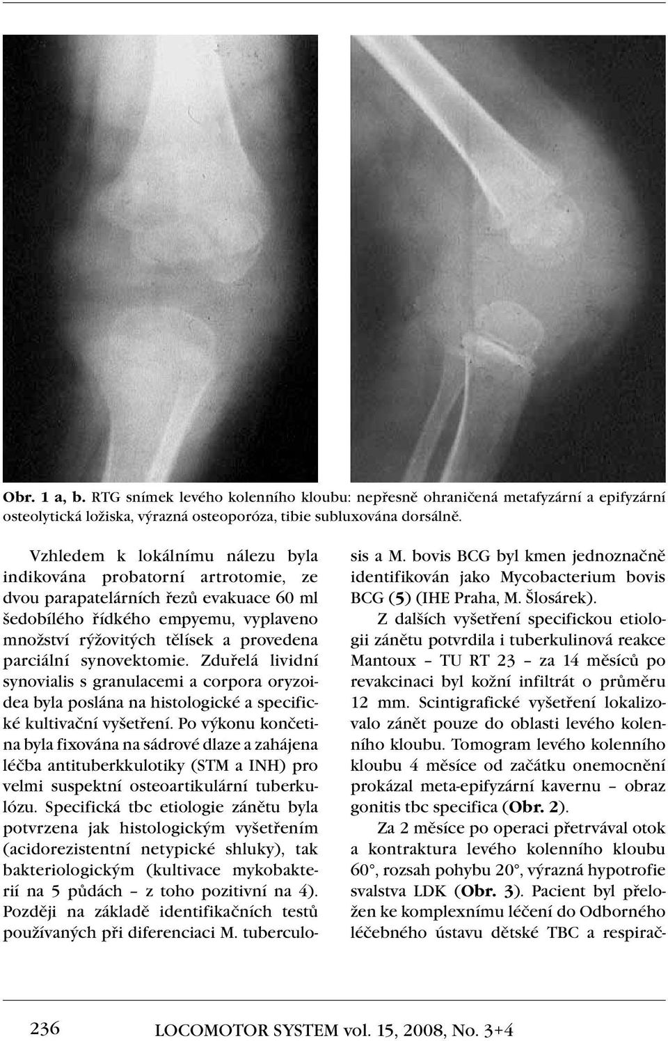 synovektomie. Zduřelá lividní synovialis s granulacemi a corpora oryzoidea byla poslána na histologické a specifické kultivační vyšetření.