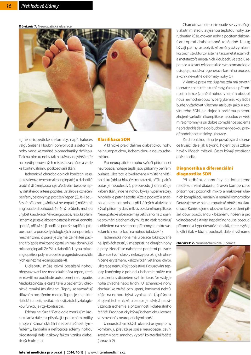ateroskleróza tepen (makroangiopatie) u diabetiků probíhá difúzněji, zasahuje především bércové tepny distálně od arteria poplitea. Ustálilo se označení periferní, bércový typ postižení tepen (3).