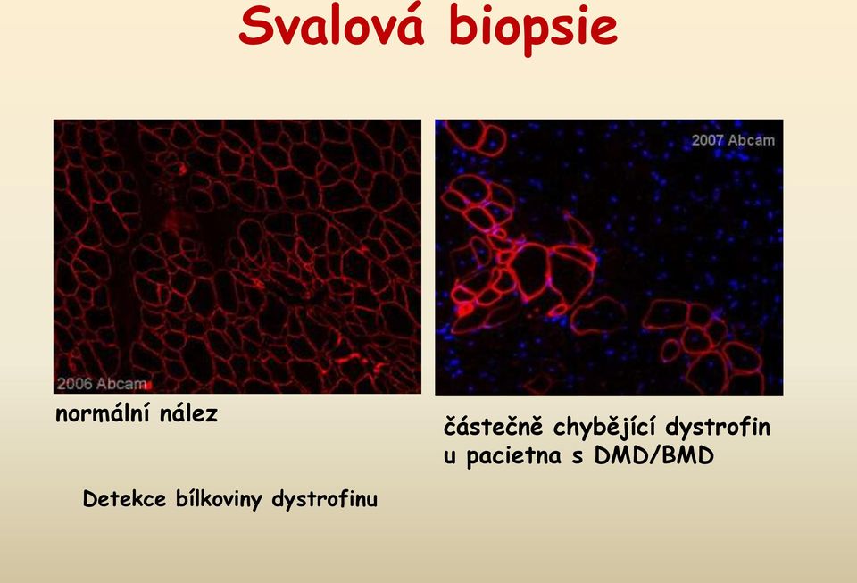 dystrofin u pacietna s