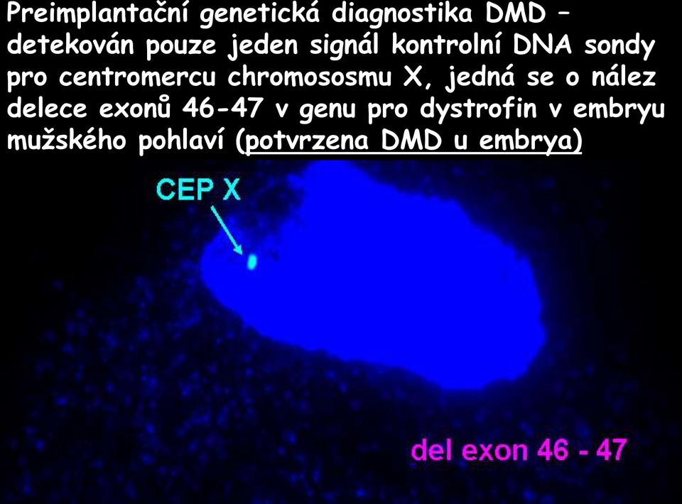 centromercu chromososmu X, jedná se o nález delece exonů