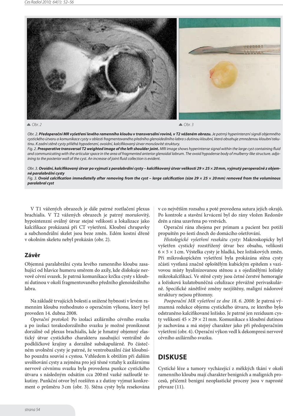 K zadní stěně cysty přiléhá hypodenzní, ovoidní, kalcifikovaný útvar morušovité struktury. Fig. 2. Preoperative transversal T2 weighted image of the left shoulder joint.