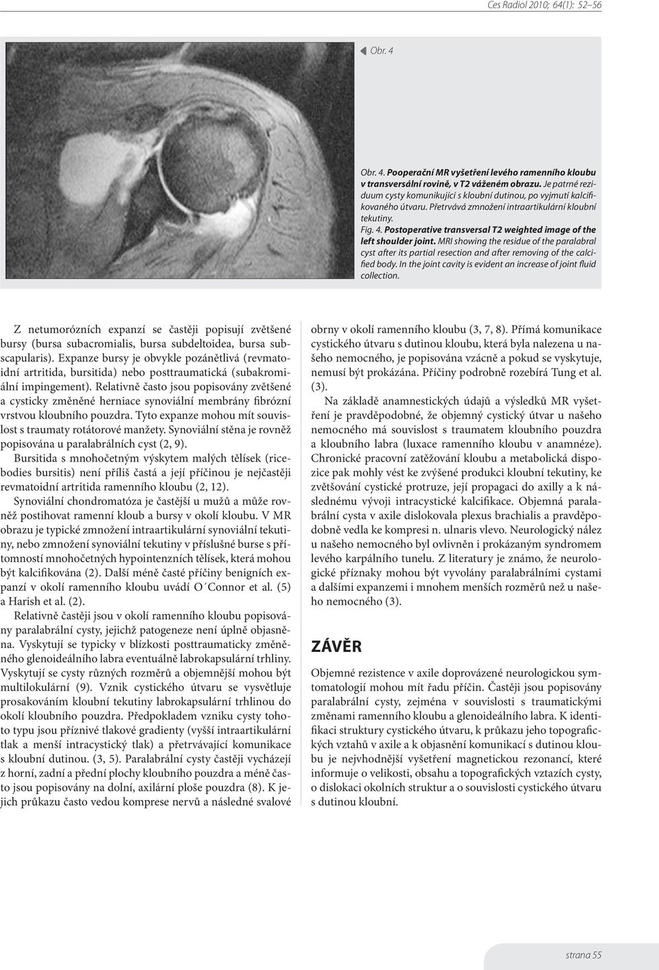 MRI showing the residue of the paralabral cyst after its partial resection and after removing of the calcified body. In the joint cavity is evident an increase of joint fluid collection.