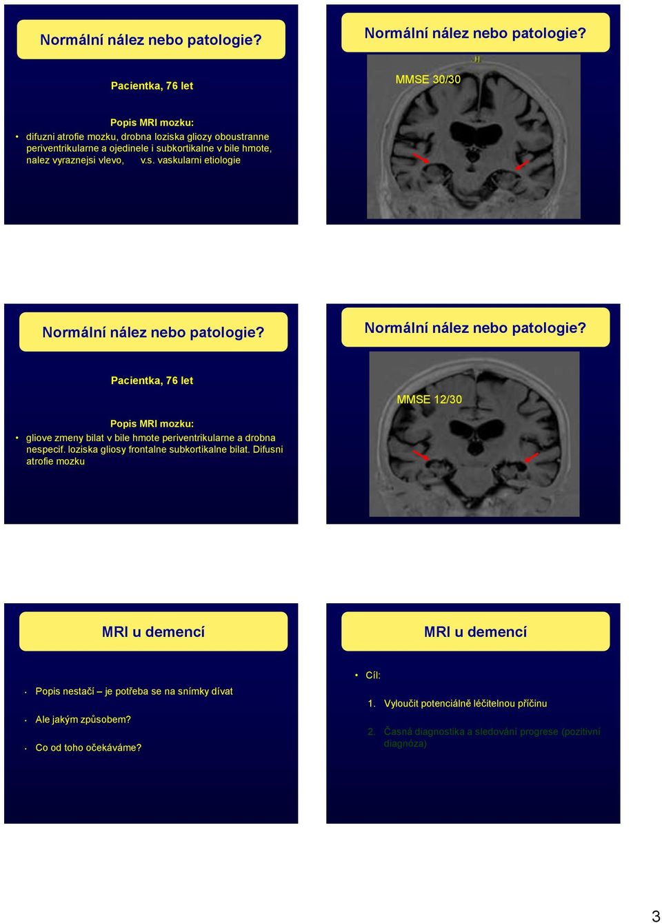v.s. vaskularni etiologie  Pacientka, 76 let MMSE 12/30 Popis MRI mozku: gliove zmeny bilat v bile hmote periventrikularne a drobna nespecif. loziska gliosy frontalne subkortikalne bilat.