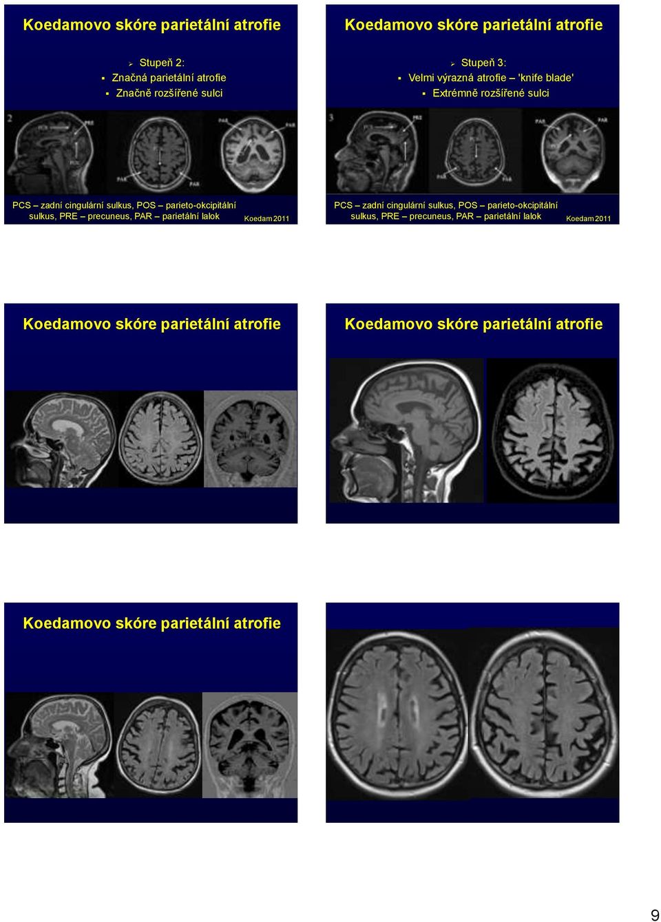 sulkus, PRE precuneus, PAR parietální lalok Koedam 2011 PCS zadní cingulární sulkus, POS parieto-okcipitální sulkus, PRE